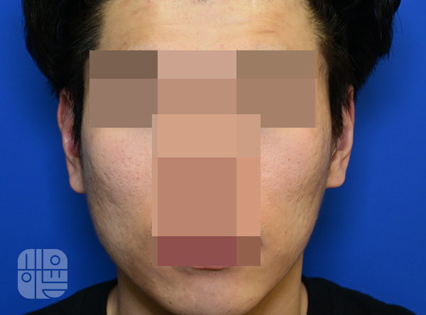 [목동점] 얼굴화농성여드름 치료 후 사진 - 해율한의원